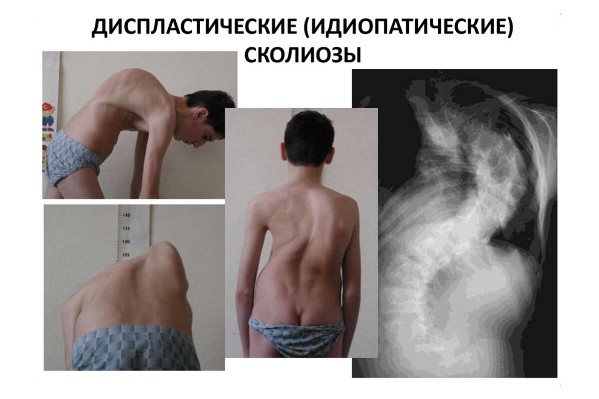 Идиопатический сколиоз Идиопатический сколиоз