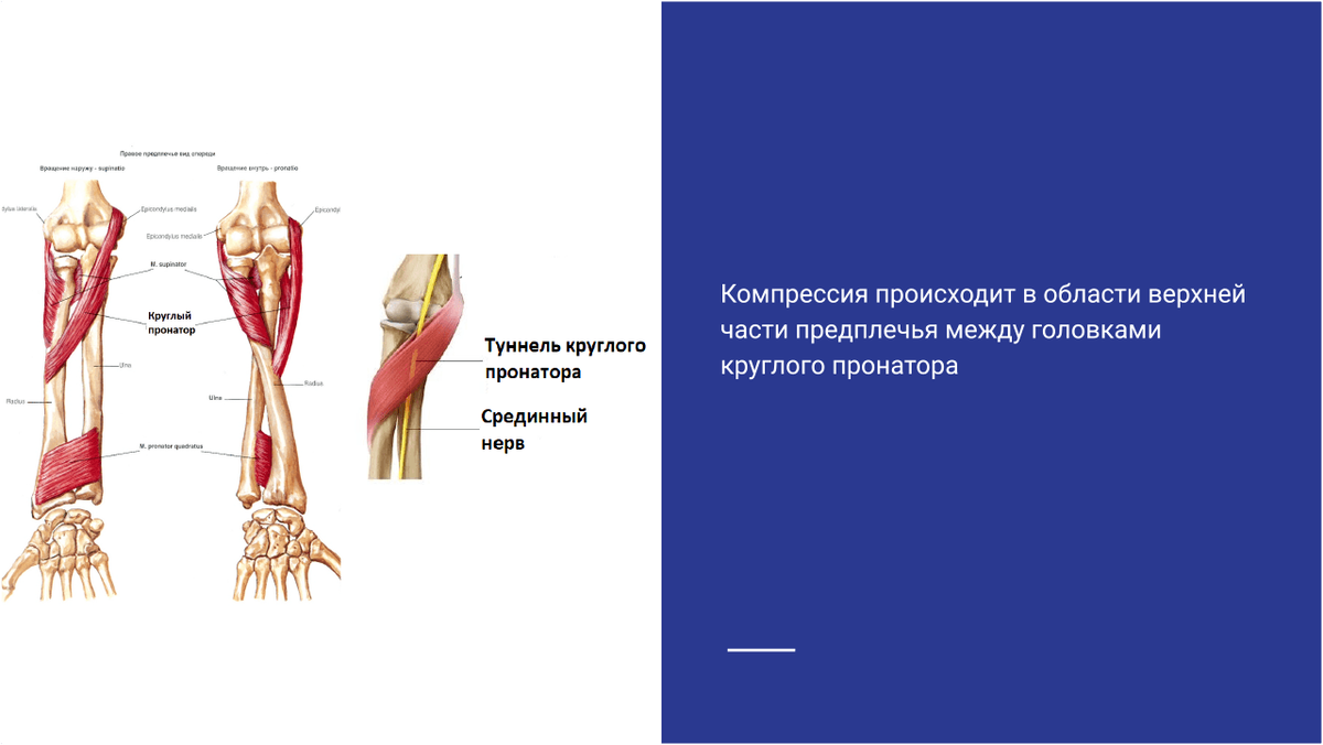 Синдром круглого пронатора Синдром круглого пронатора
