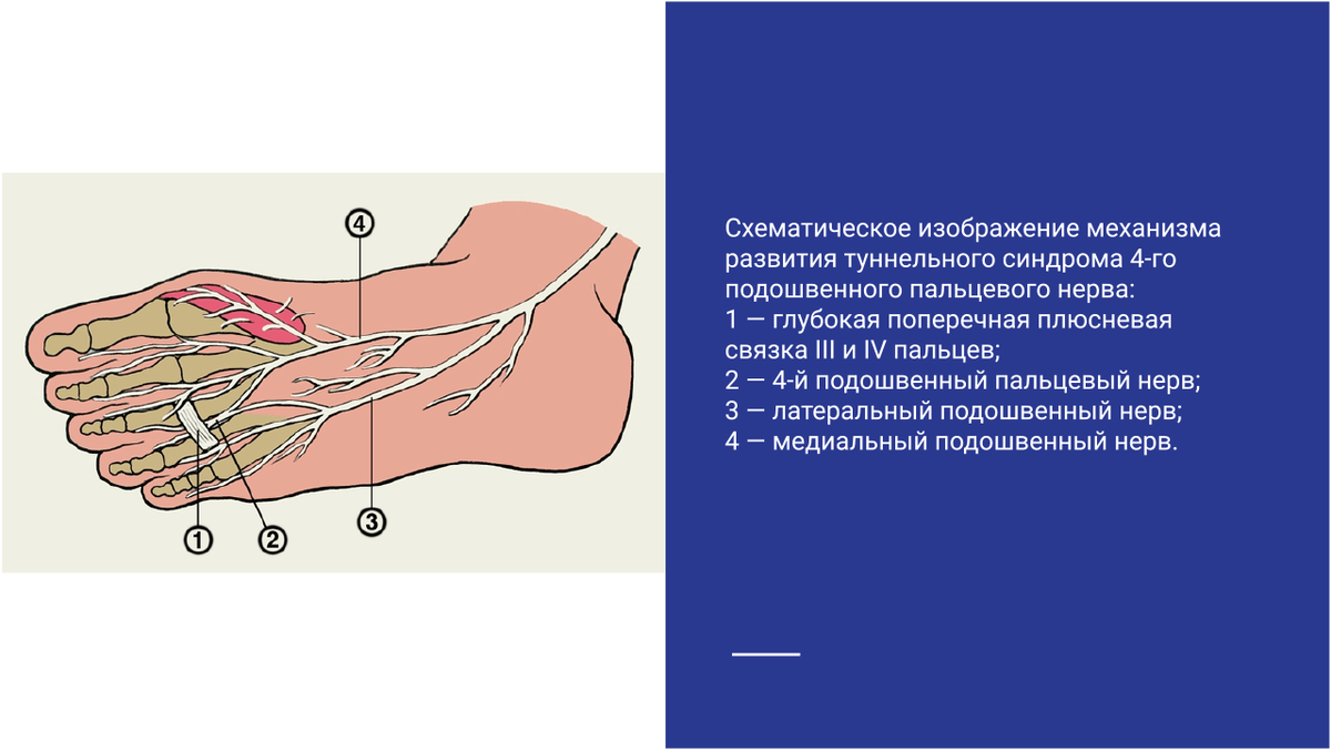 Схематическое изображение механизма развития туннельного синдрома Схематическое изображение механизма развития туннельного синдрома