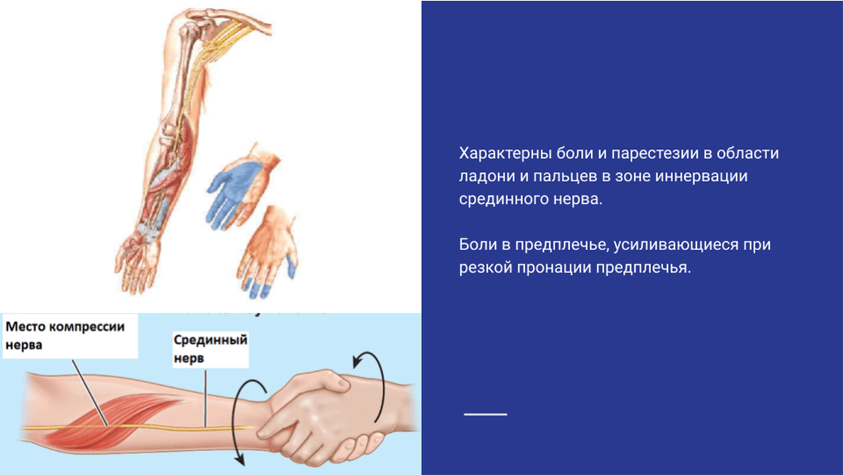 Боль при синдроме круглого пронатора предплечья Боль при синдроме круглого пронатора предплечья