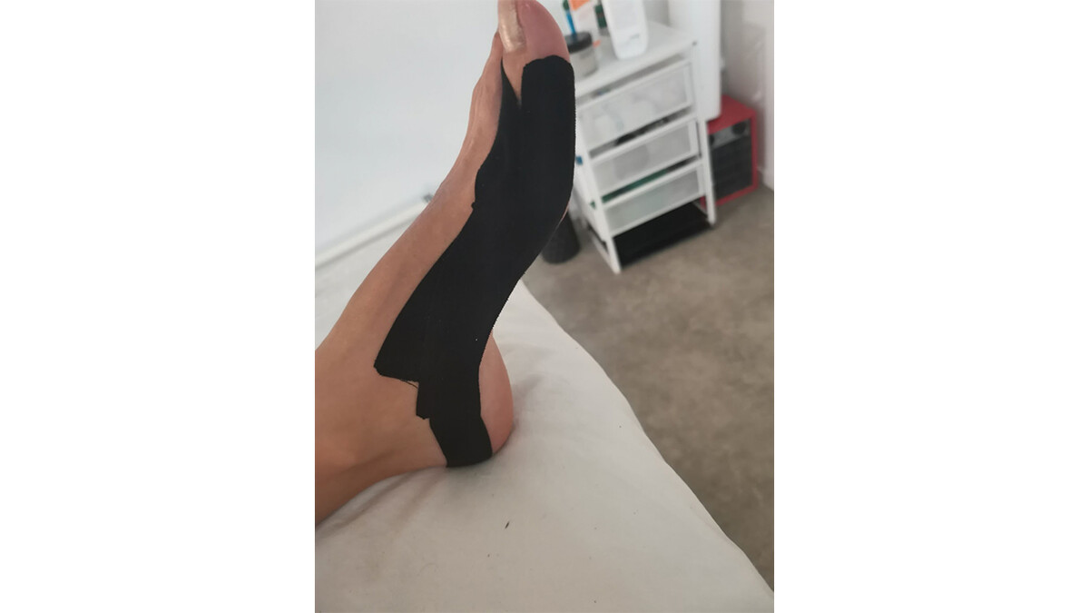 Пример аппликации при Hallyx Valgus 2 Пример аппликации при Hallyx Valgus 2