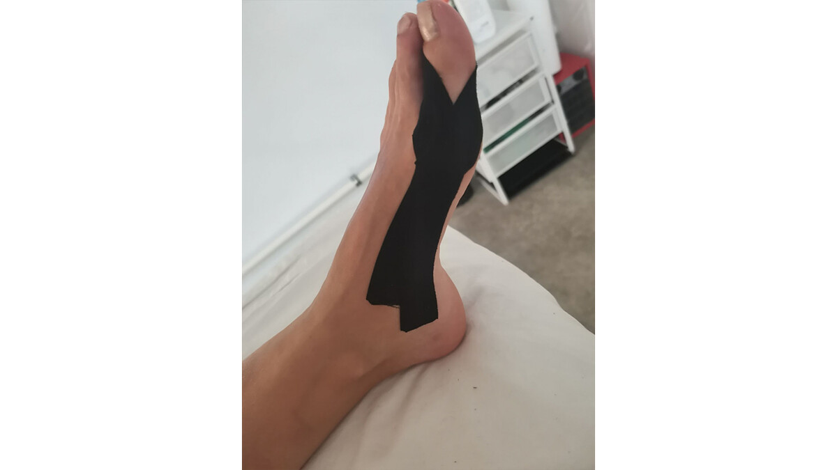 Пример аппликации при Hallyx Valgus 1 Пример аппликации при Hallyx Valgus 1