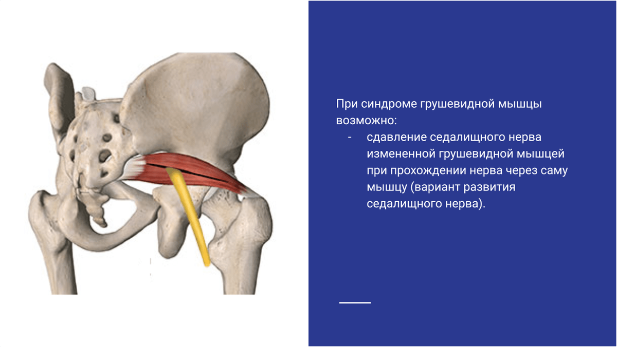 Сдавление седалищного нерва измененной грушевидной мышцей при прохождении нерва через саму мышцу Сдавление седалищного нерва измененной грушевидной мышцей при прохождении нерва через саму мышцу
