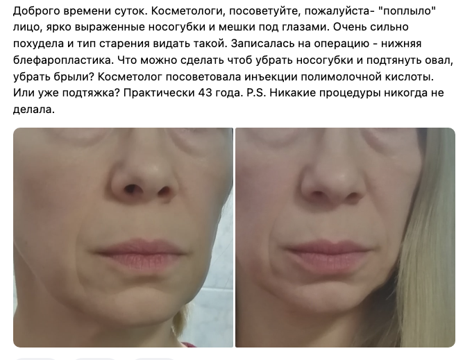<p>Обычные горе-похудения у женщин и лица бабок. Обратите внимание, как уехала максилла, кость молодости (центральная лицевая кость): и расстояние от губы до носа стало возрастным, огромным. Доголодалась. </p> <p>Обычные горе-похудения у женщин и лица бабок. Обратите внимание, как уехала максилла, кость молодости (центральная лицевая кость): и расстояние от губы до носа стало возрастным, огромным. Доголодалась. </p>