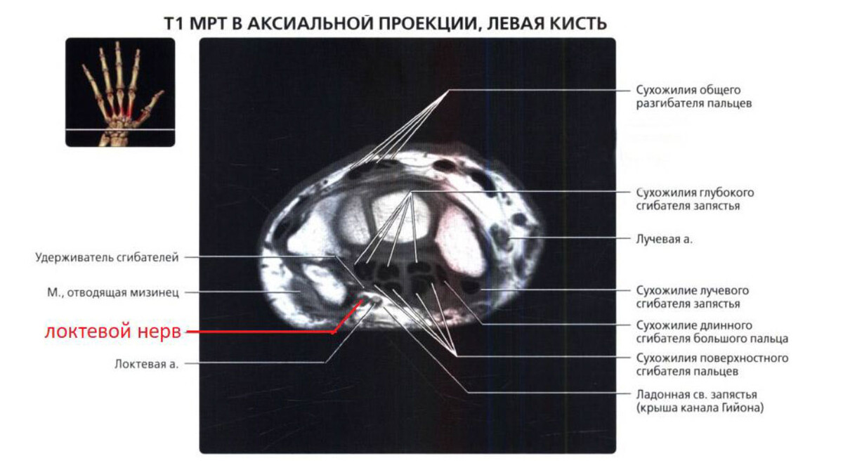 МРТ при синдроме канала Гийона МРТ при синдроме канала Гийона
