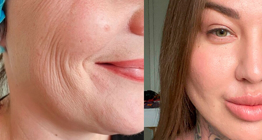 <p><em>На фото слева — моя ровесница 40+. Стареющая, морщинистая кожа, потому что недостаточно белка в рационе. Но если она и добавит его, он картины не поменяет — уже, скорее всего, «убит» кишечник и обмен веществ. Без специального восстановления не будет никаких результатов и сдвига в качестве тела.</em> </p>
<p><em>На фото слева — моя ровесница 40+. Стареющая, морщинистая кожа, потому что недостаточно белка в рационе. Но если она и добавит его, он картины не поменяет — уже, скорее всего, «убит» кишечник и обмен веществ. Без специального восстановления не будет никаких результатов и сдвига в качестве тела.</em> </p>