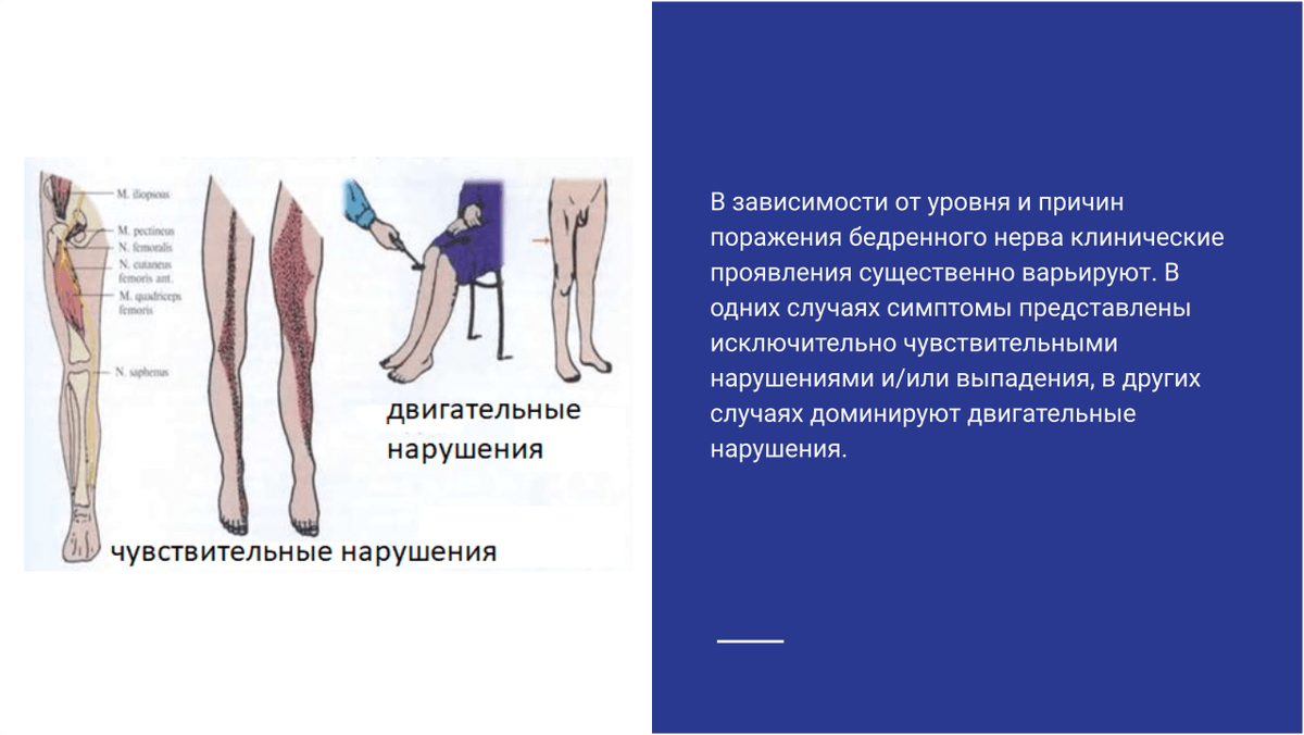 Клинические проявления компрессионно-ишемической невропатии бедренного нерва. Клинические проявления компрессионно-ишемической невропатии бедренного нерва.