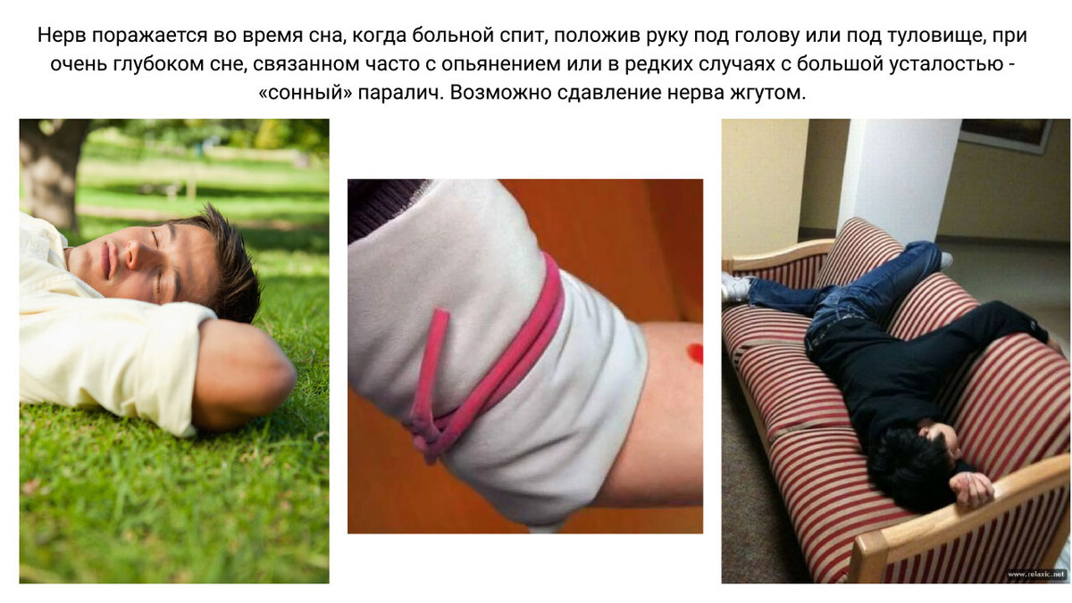 Поражение лучевого нерва во время сна Поражение лучевого нерва во время сна