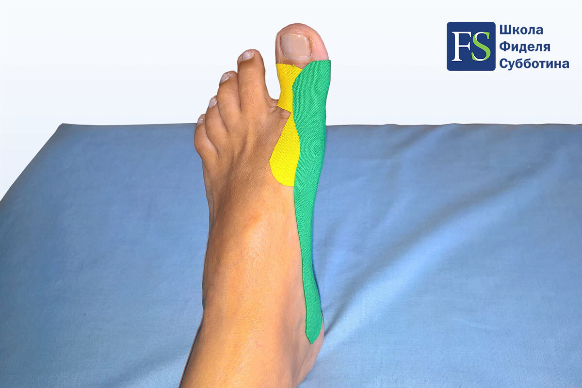 Статодинамическое тейпирование стопы при Халюс Вальгус (Hallux Valgus) - 6 Статодинамическое тейпирование стопы при Халюс Вальгус (Hallux Valgus) - 6