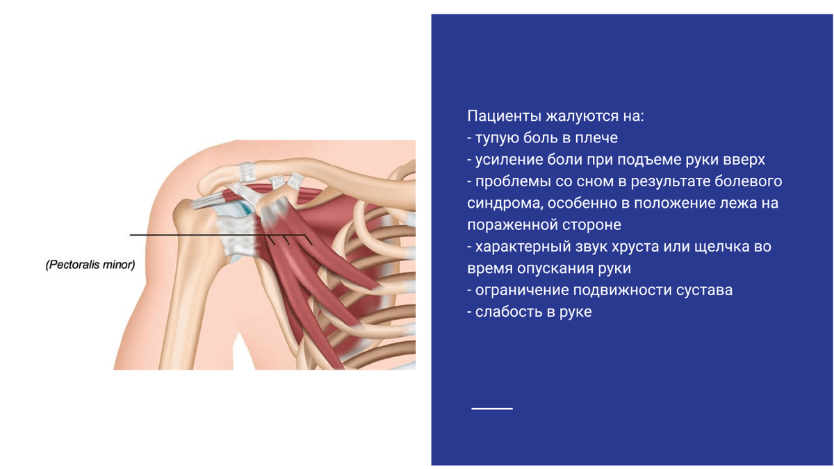 Жалобы пациентов при туннельном синдроме малой грудной мышцы Жалобы пациентов при туннельном синдроме малой грудной мышцы