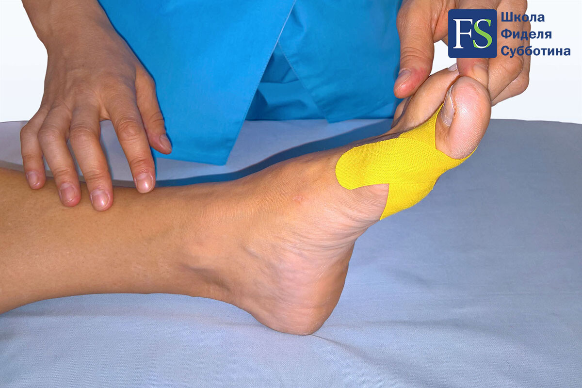 Статодинамическое тейпирования стопы при Халюс Вальгус (Hallux Valgus) - 4 Статодинамическое тейпирования стопы при Халюс Вальгус (Hallux Valgus) - 4