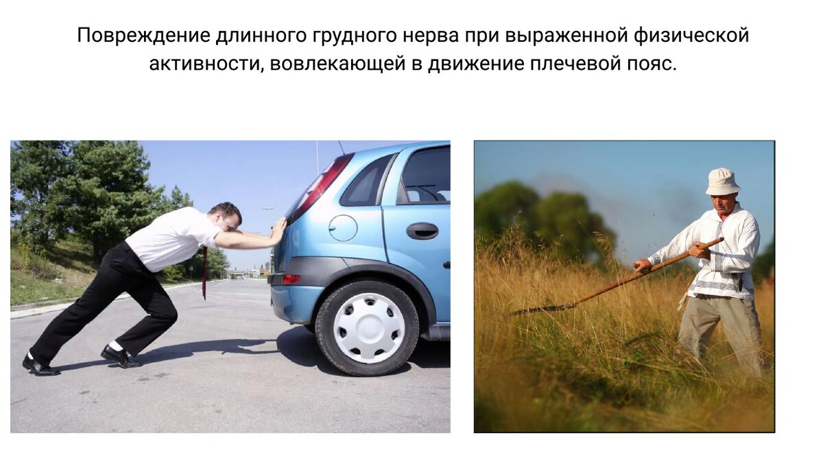 Причины повреждение длинного грудного нерва Причины повреждение длинного грудного нерва
