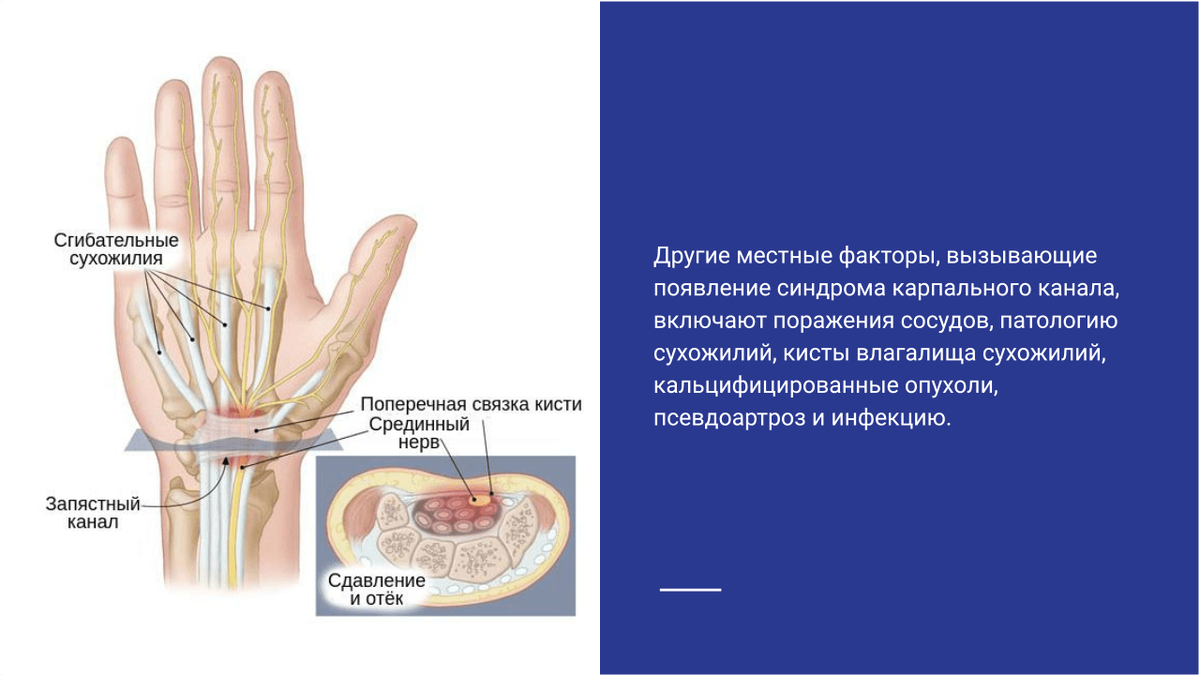 Факторы вызывающие появление синдрома карпального канала Факторы вызывающие появление синдрома карпального канала