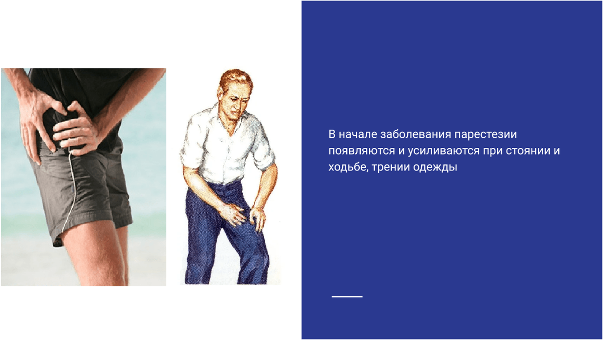 Боль при ходьбе в начале заболевания парестетической мералгией Бернгардта - Рота Боль при ходьбе в начале заболевания парестетической мералгией Бернгардта - Рота
