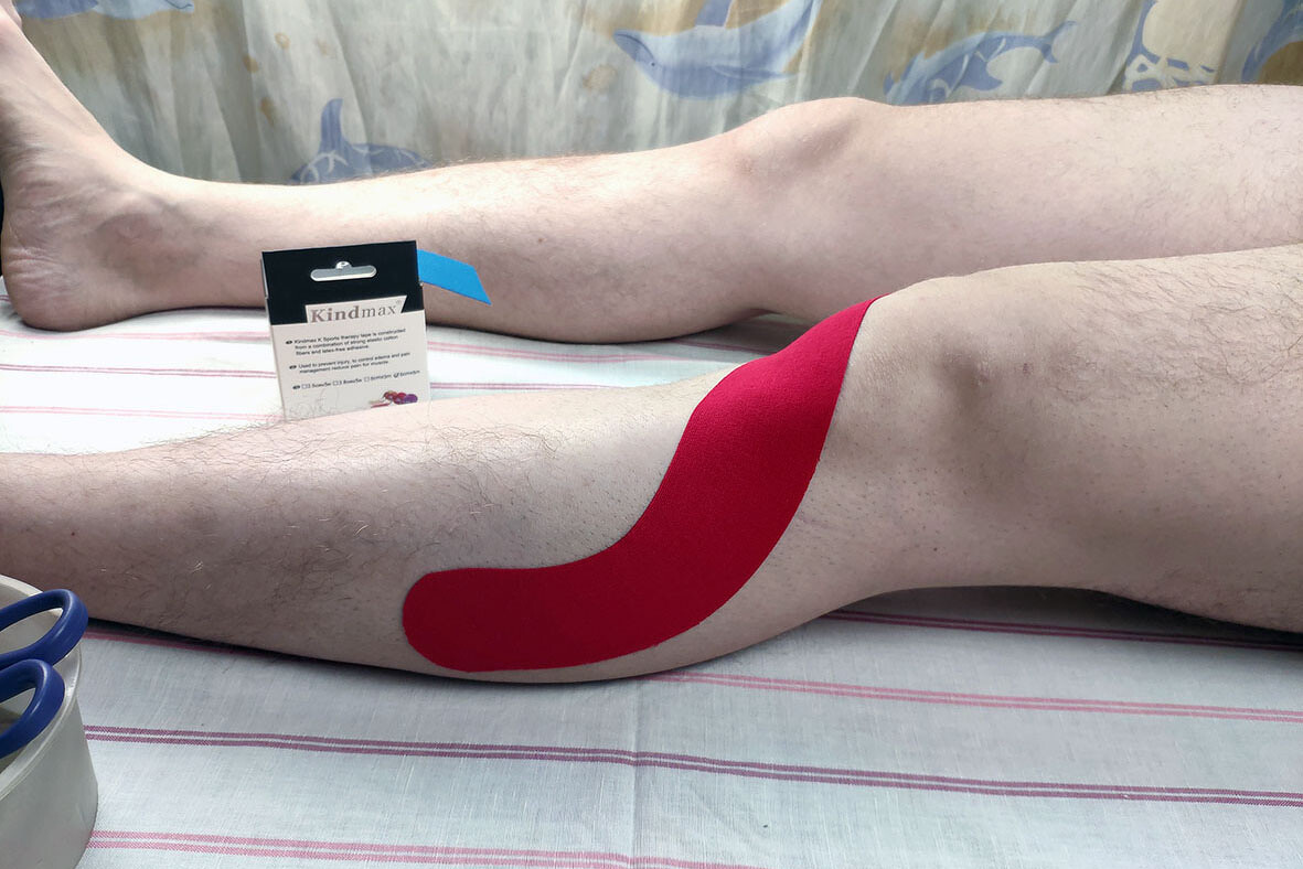 Фото 3. Тейпирование для стабилизации коленного сустава - наклеивании нижнего края первого отрезка