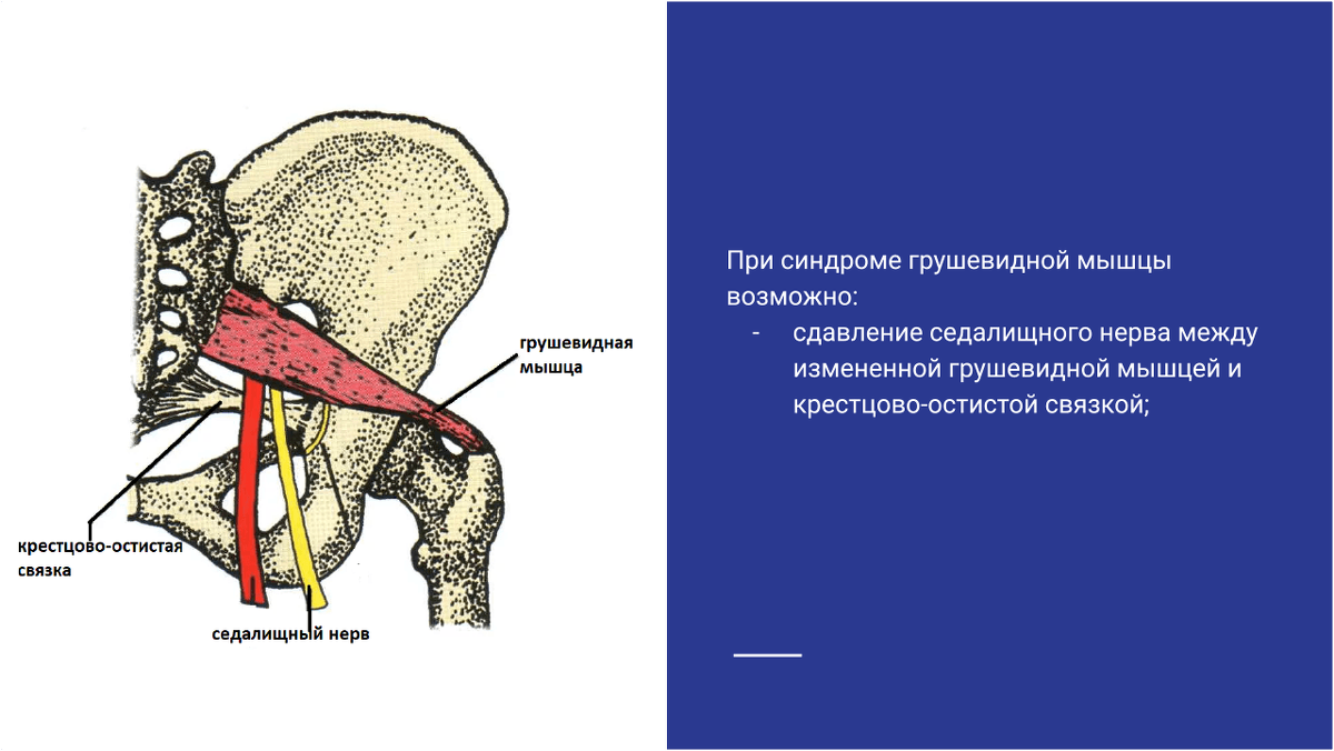 Сдавление седалищного нерва между измененной грушевидной мышцей и крестцово-остистой связкой