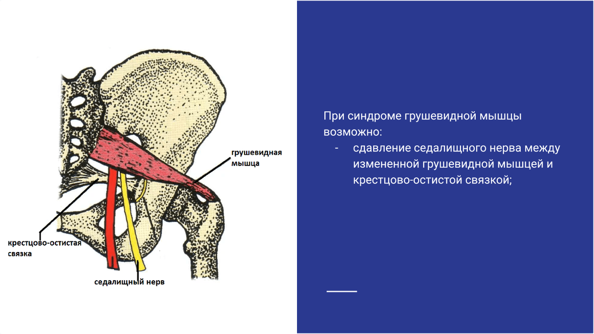 Сдавление седалищного нерва между измененной грушевидной мышцей и крестцово-остистой связкой