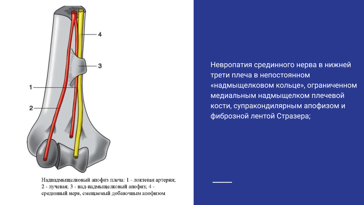 Компрессия срединного нерва