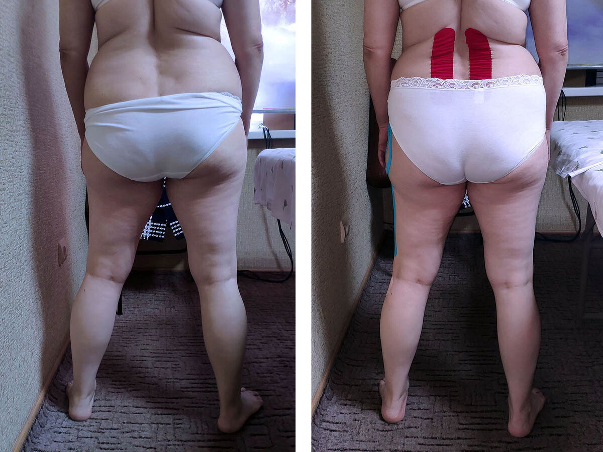 Фото 10. До и после лечения тазобедренного сустава