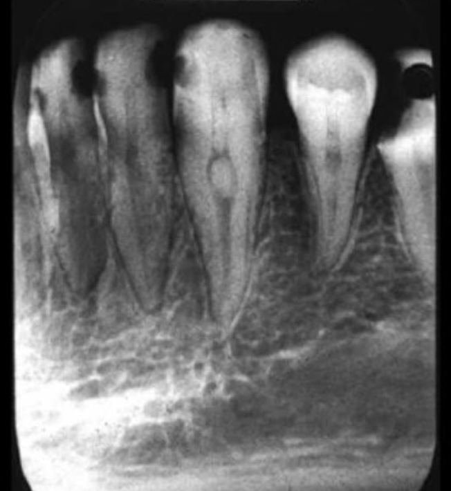 Дентикли в пульпе рентген. Конкрементозный пульпит рентген. Интерстициальные дентикли.