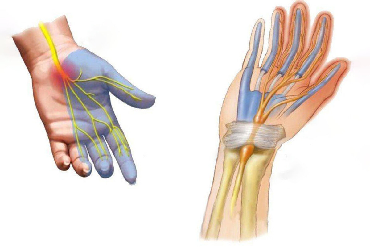 Нейропатия карпального канала