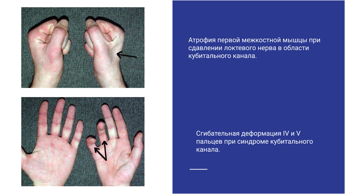 Атрофия первой межкостной мышцы и сгибательная деформация 4 и 5 пальцев