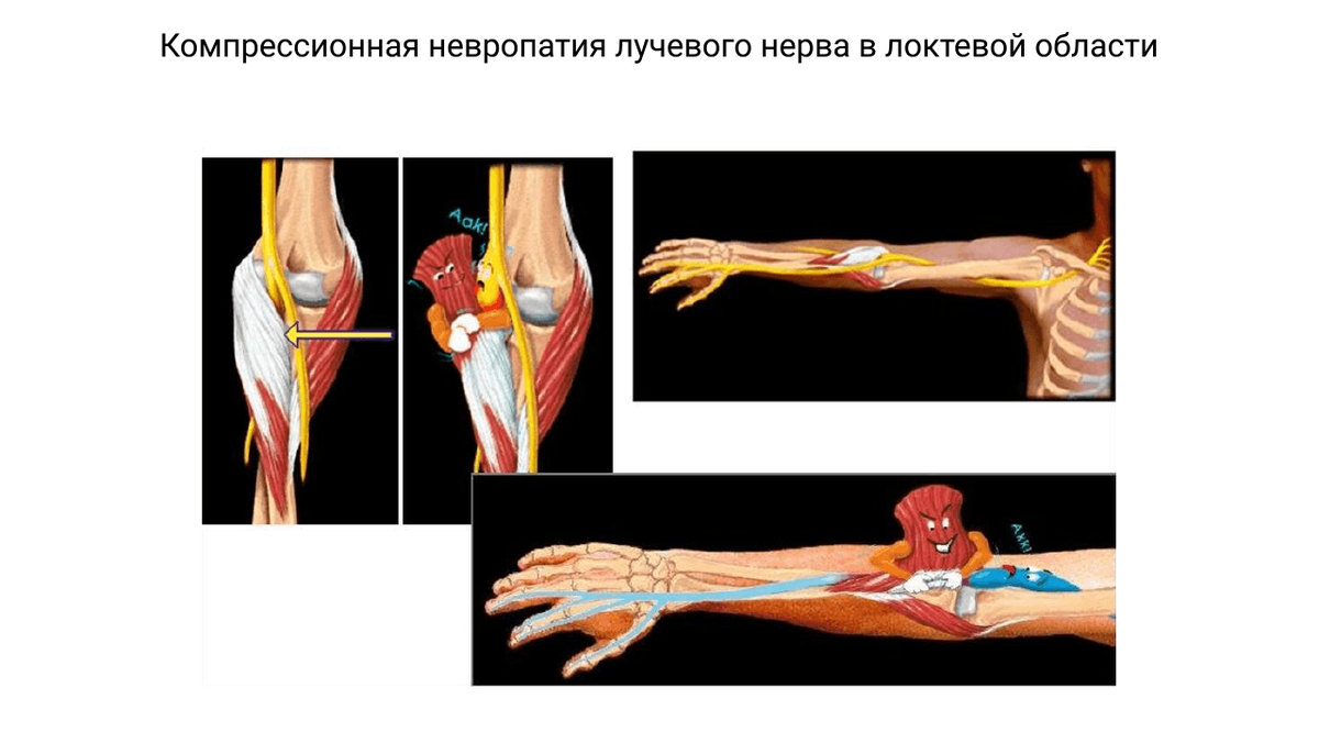 Компрессионная нейропатия локтевого нерва. Синдром компрессии лучевого нерва. Нейропатия локтевого нерва синдром. Локтевой нерв анатомия нейропатия.