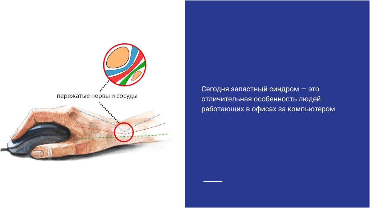 Запястный синдром симптомы
