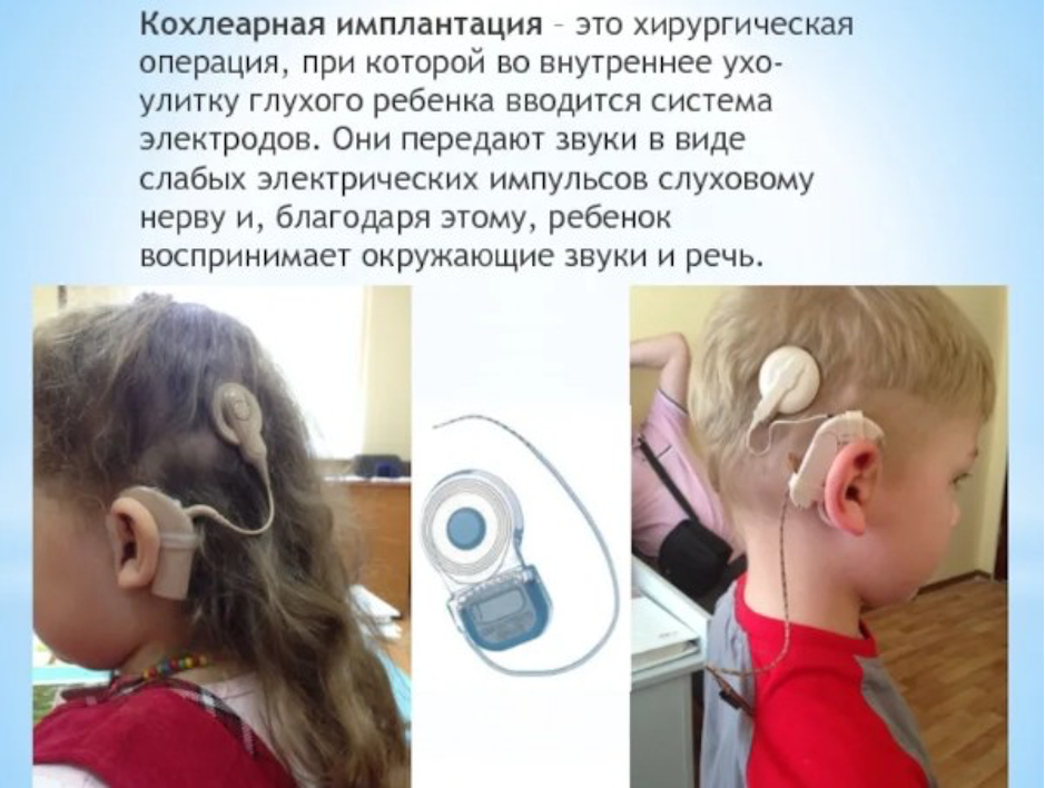 Операция на ухо на слух. Кохлеарный аппарат. Кохлеарный имплантат и слуховой аппарат. Крохлеарная имплата.
