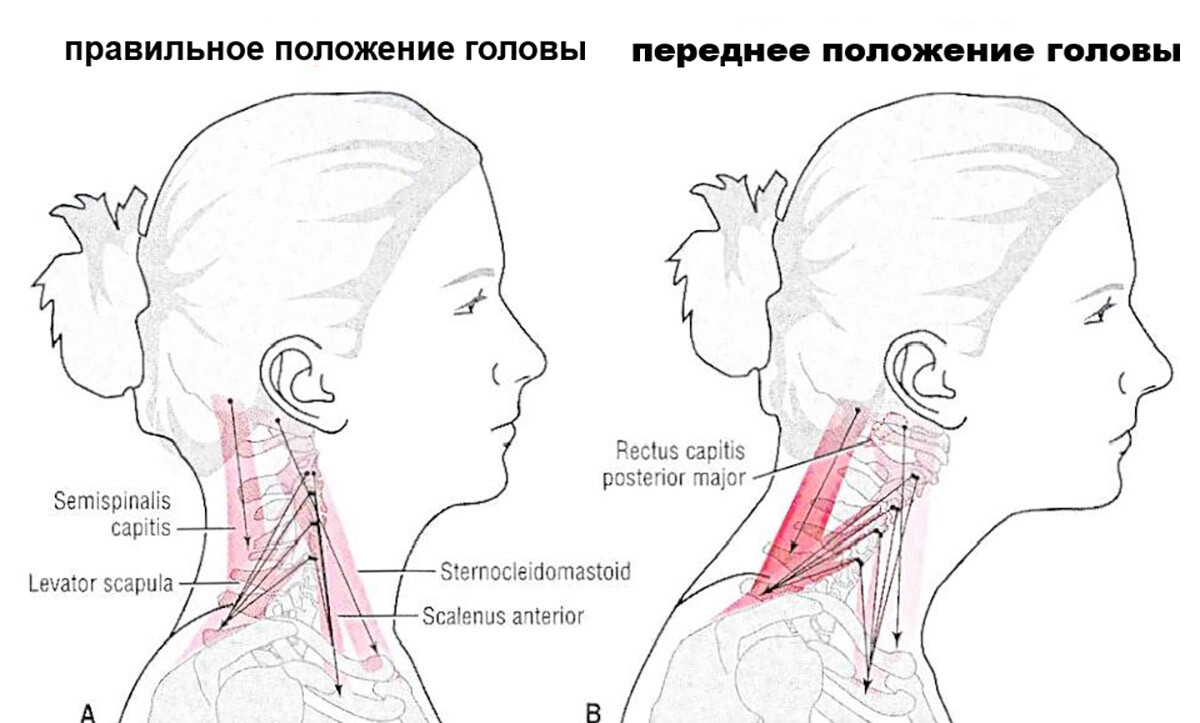  переднее положение головы (forward head posture)