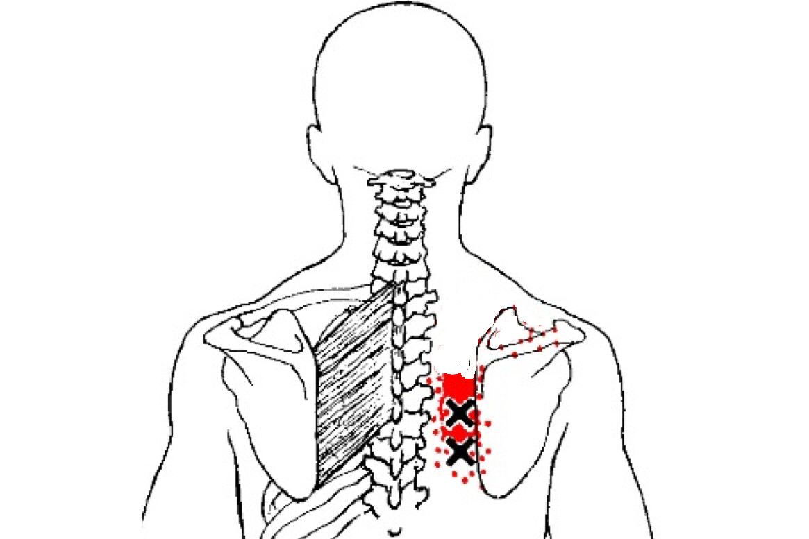 Боль при поражении большой ромбовидной мышцы