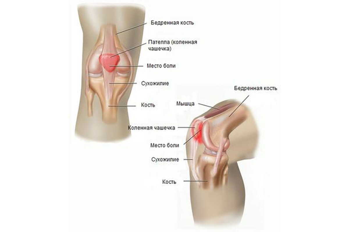 Боли коленного сустава симптомы