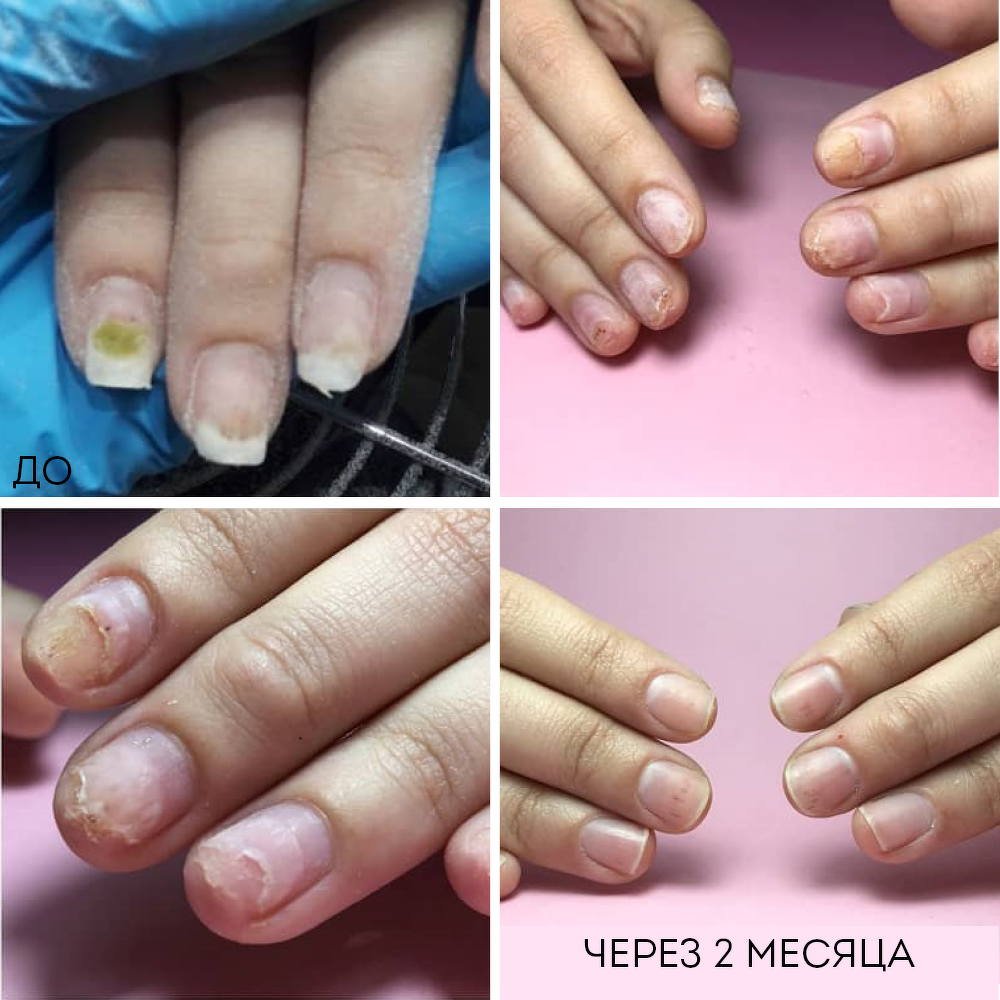 Восстановление натуральных ногтей при онихолизисе и онихорексисе