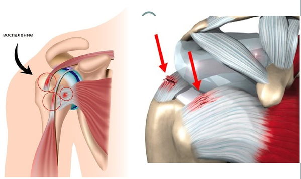 Импиджмент синдром плечевого сустава. Статьи