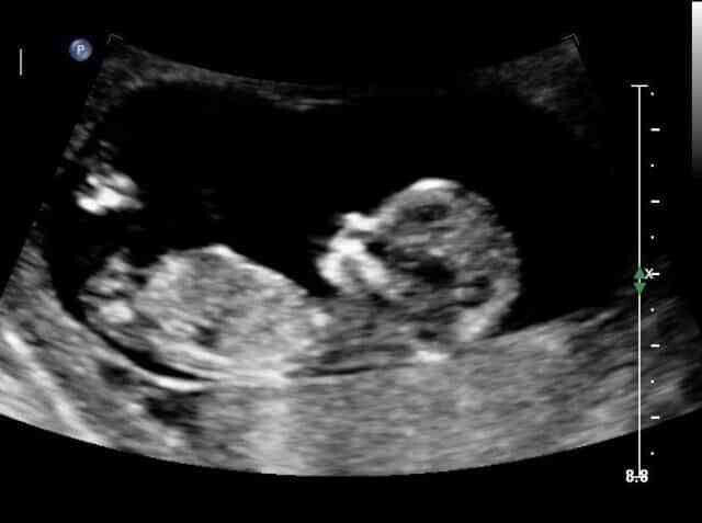 Фото ребенка в 9 недель беременности фото узи