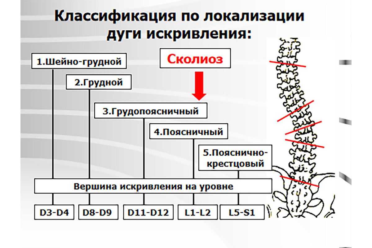 Классификация по локализации дуги искривления позвоночника