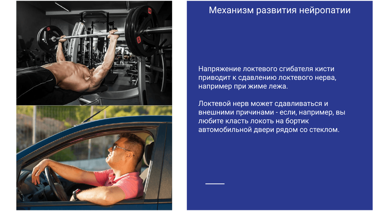 Синдром кубитального канала.. Статьи