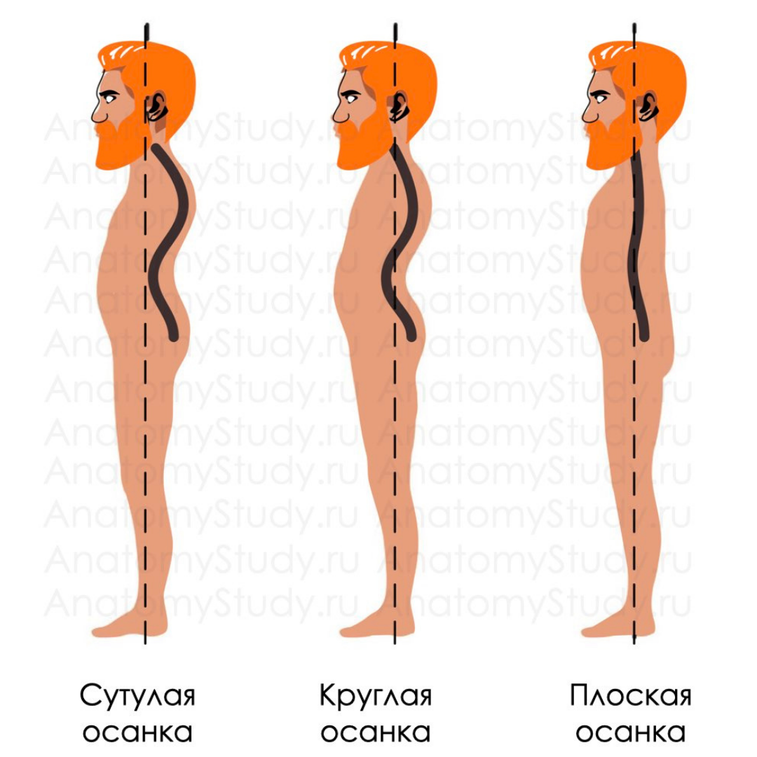 сколиоз одна грудь больше фото 82