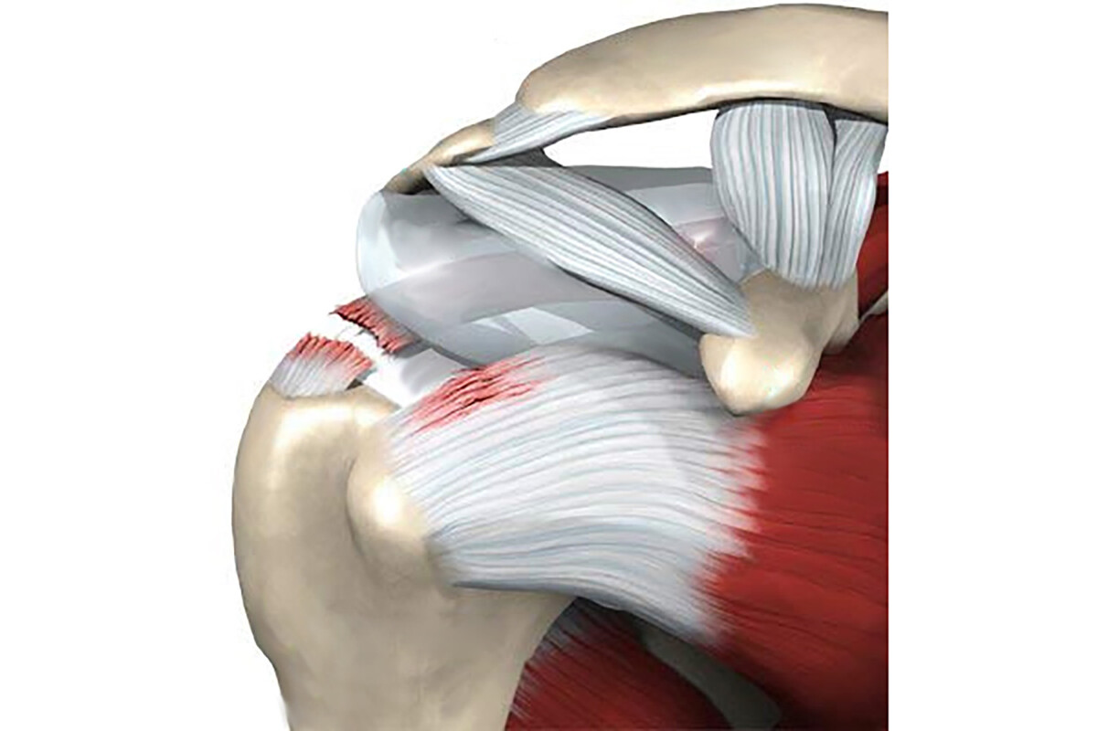 Повреждение сухожилий надостной мышцы