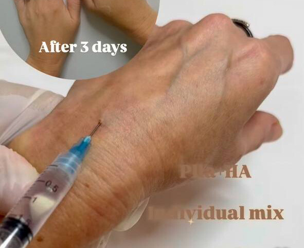 
		<p><em>Морщинистые кисти — дефицит белка и коллагена</em></p>	