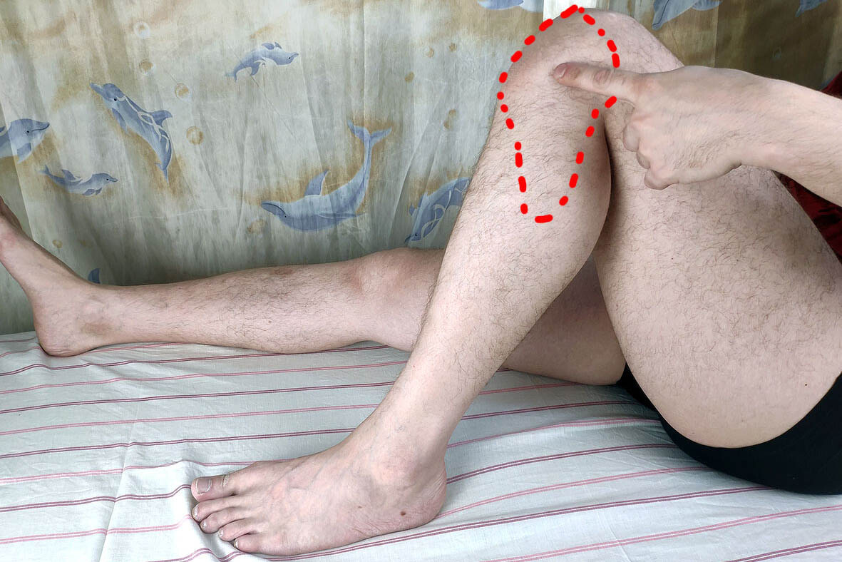 Фото 1. Область боли в коленном суставе