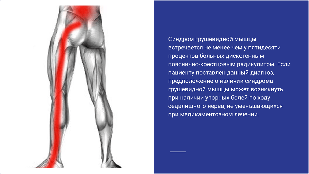 Синдром грушевидной мышцы картинки
