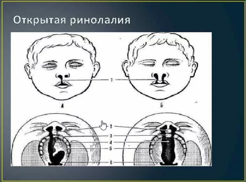 Обозначьте на рисунке виды расщелин