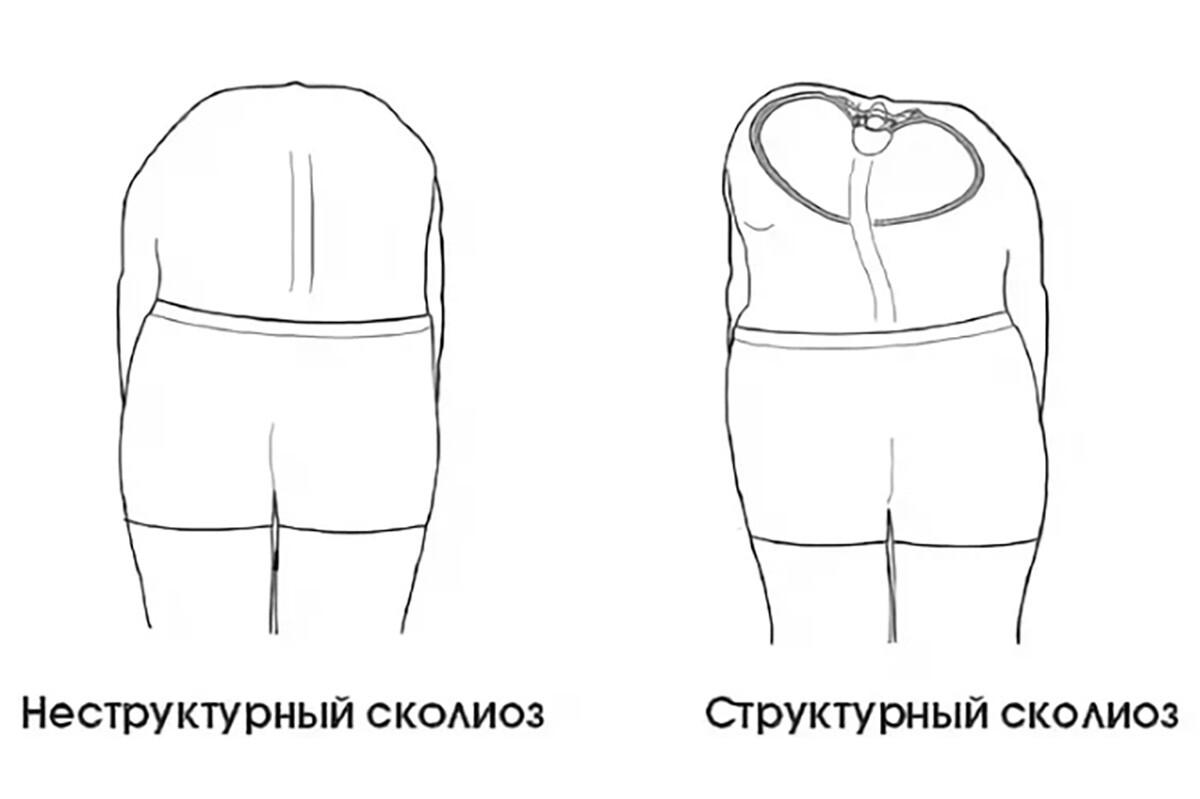 Структурный и функциональный сколиоз