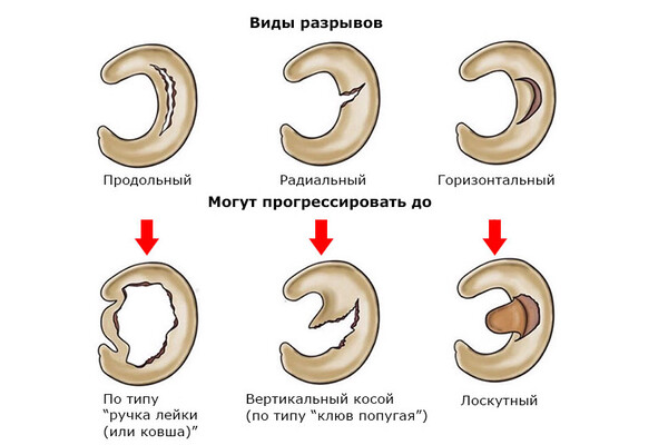 Биомеханика травмы менисков коленного сустава. Статьи
