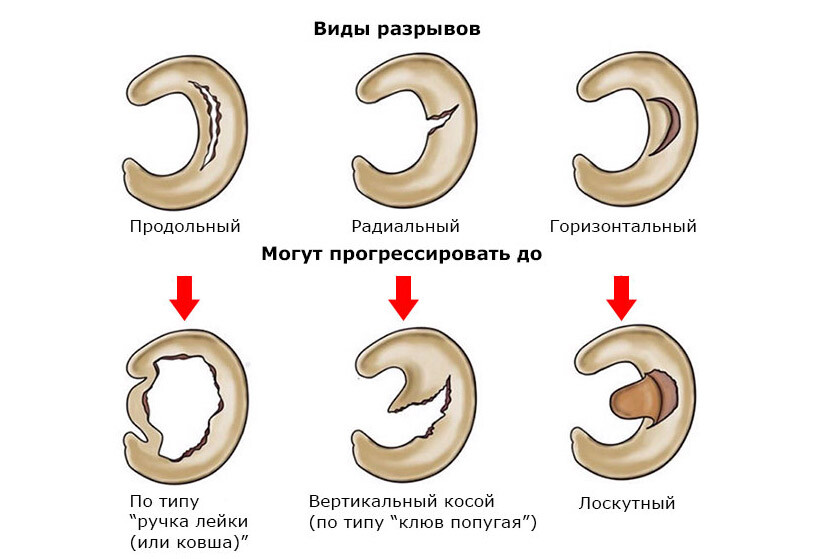 Виды разрывов мениска
