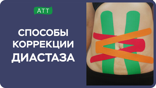Диастаз прямых мышц живота. Статьи от Академии - ТТ