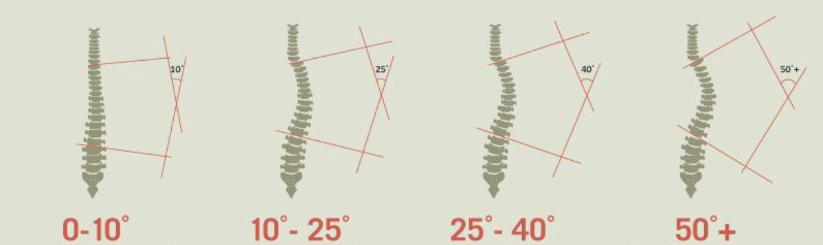 Степени искривления позвоночника