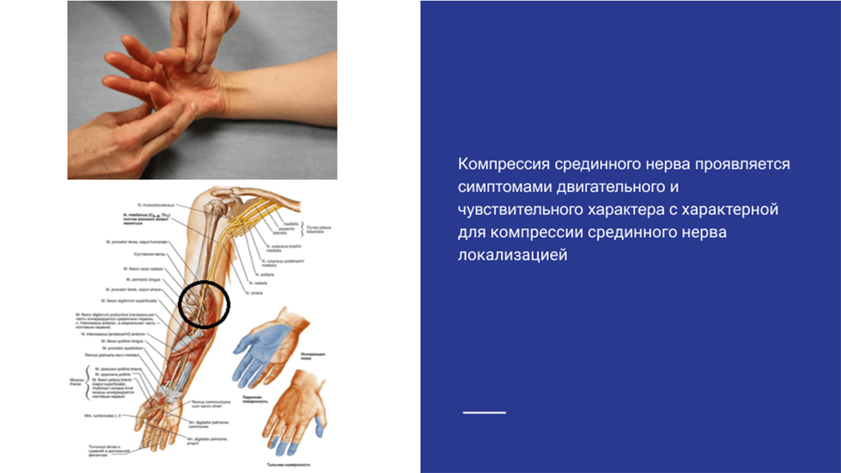 Проявления компрессии срединного нерва